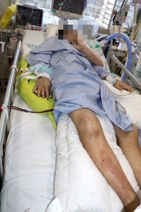 ICU:リスク軽減のために、分割して複数組み合わせて使用①