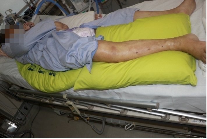 ICU:リスク軽減のために、分割して複数組み合わせて使用➁
